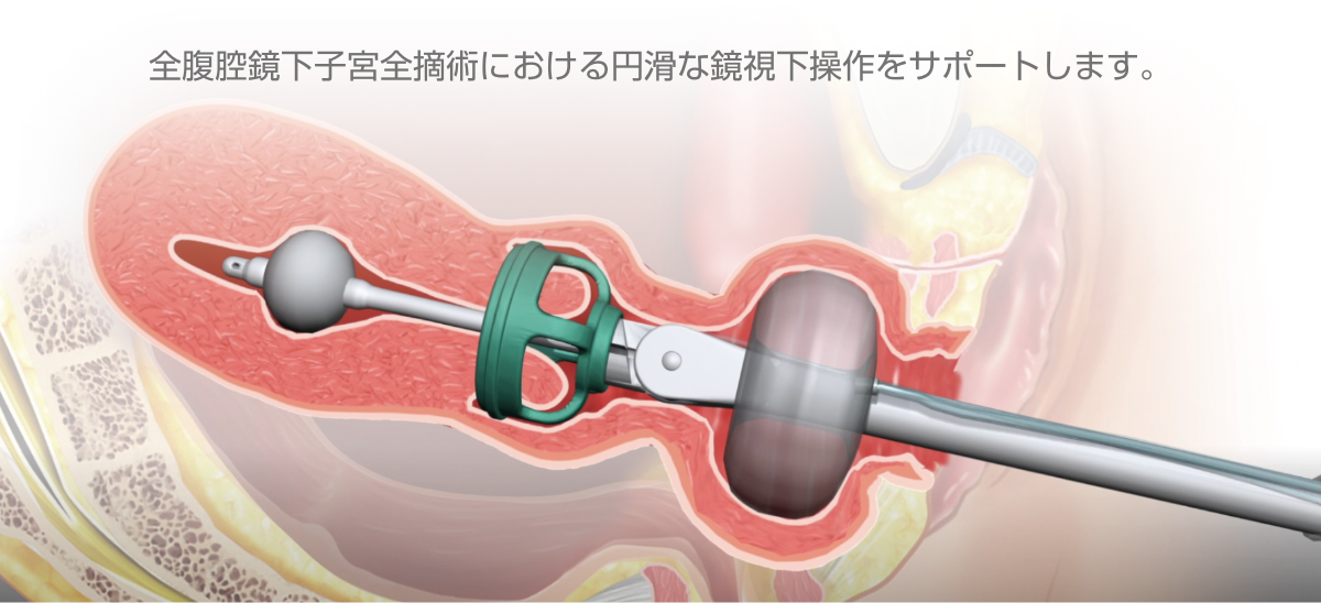 全腹腔鏡下子宮全摘術における円滑な鏡視下操作をサポート